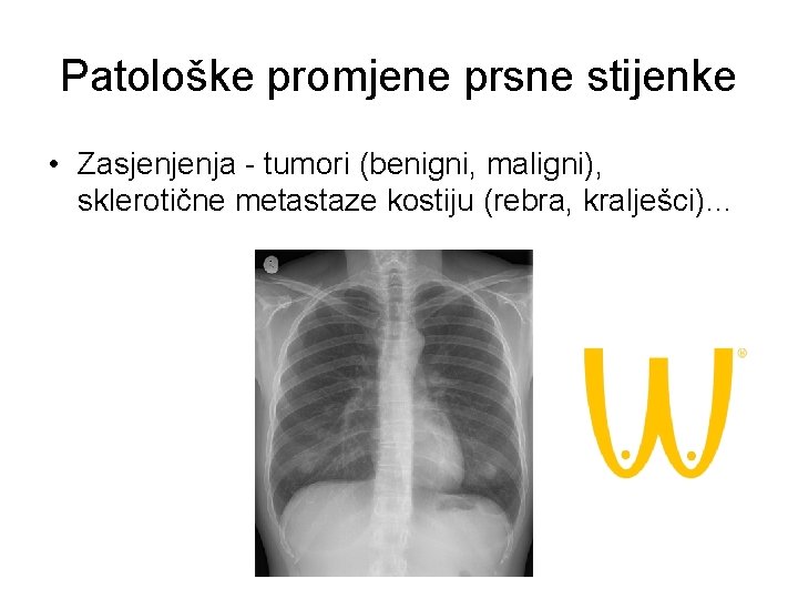 Patološke promjene prsne stijenke • Zasjenjenja - tumori (benigni, maligni), sklerotične metastaze kostiju (rebra,