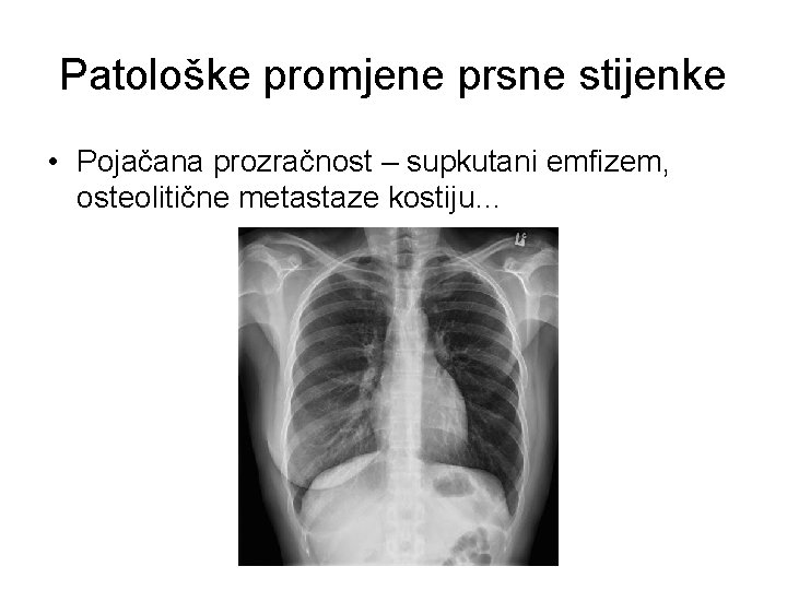 Patološke promjene prsne stijenke • Pojačana prozračnost – supkutani emfizem, osteolitične metastaze kostiju… 