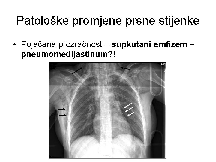 Patološke promjene prsne stijenke • Pojačana prozračnost – supkutani emfizem – pneumomedijastinum? ! 