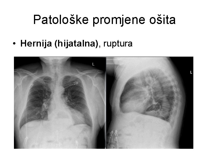 Patološke promjene ošita • Hernija (hijatalna), ruptura 