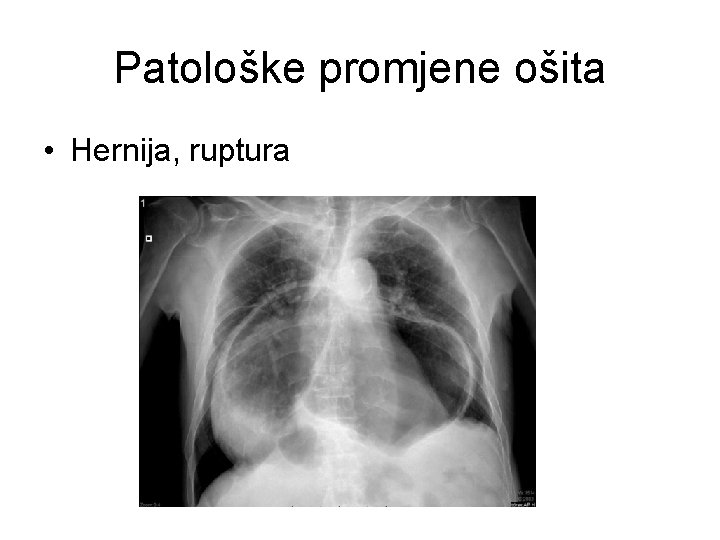 Patološke promjene ošita • Hernija, ruptura Patološke promjene ošita • Hernija, ruptura
