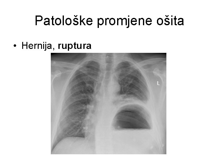 Patološke promjene ošita • Hernija, ruptura 