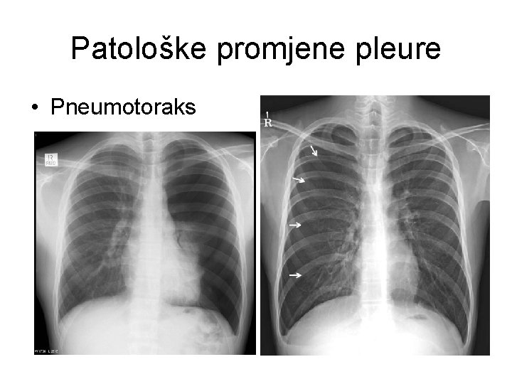 Patološke promjene pleure • Pneumotoraks Patološke promjene pleure • Pneumotoraks