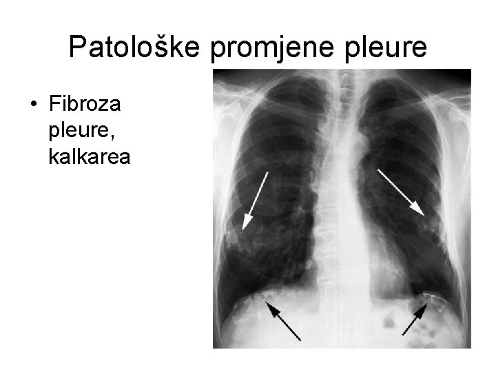 Patološke promjene pleure • Fibroza pleure, kalkarea 