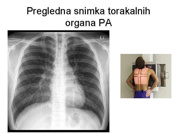 Pregledna snimka torakalnih organa PA 