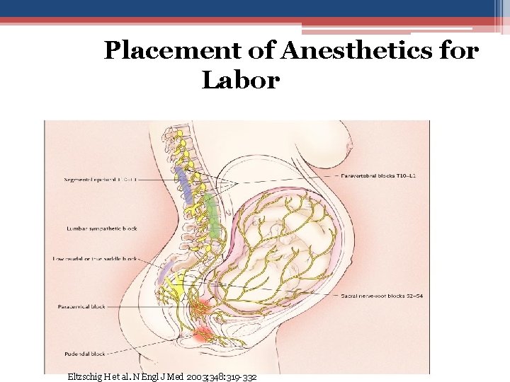 Pathways of Placement of Anesthetics for Labor Pain Eltzschig H et al. N Engl