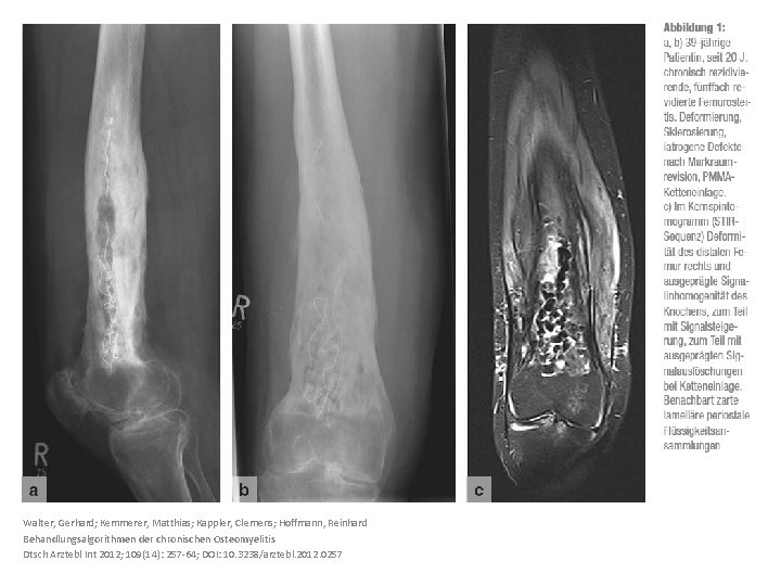 Walter, Gerhard; Kemmerer, Matthias; Kappler, Clemens; Hoffmann, Reinhard Behandlungsalgorithmen der chronischen Osteomyelitis Dtsch Arztebl