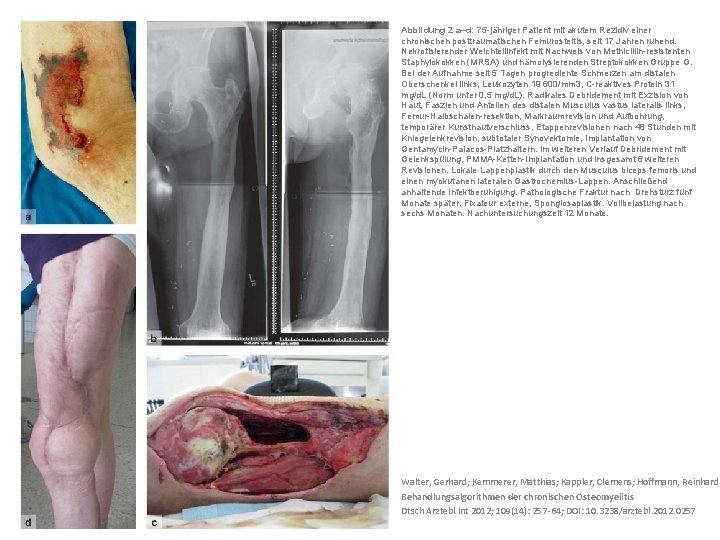 Abbildung 2 a–d: 75 -jähriger Patient mit akutem Rezidiv einer chronischen posttraumatischen Femurosteitis, seit