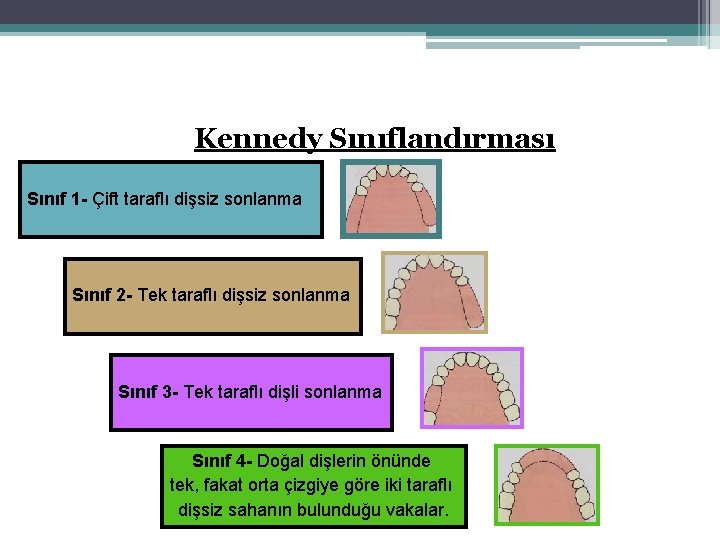 Kennedy Sınıflandırması Sınıf 1 - Çift taraflı dişsiz sonlanma Sınıf 2 - Tek taraflı