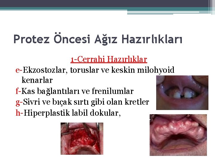 Protez Öncesi Ağız Hazırlıkları 1 -Cerrahi Hazırlıklar e-Ekzostozlar, toruslar ve keskin milohyoid kenarlar f-Kas