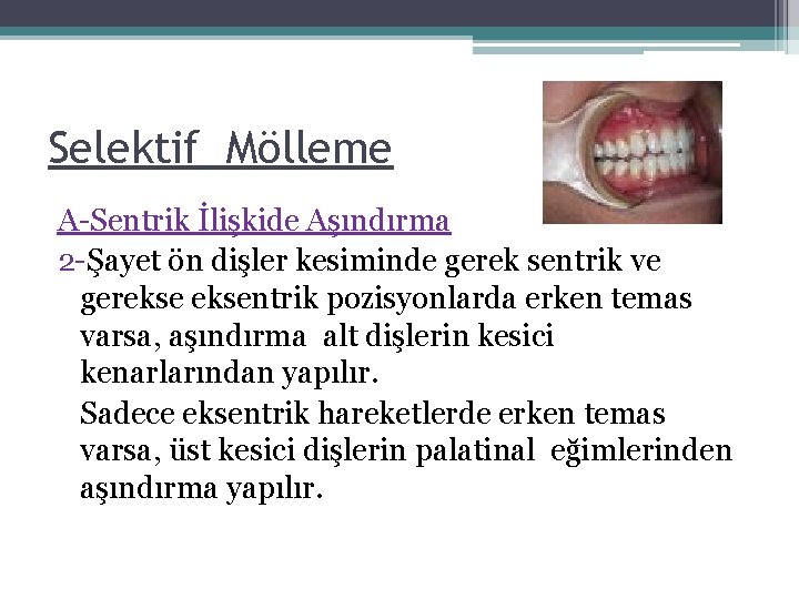 Selektif Mölleme A-Sentrik İlişkide Aşındırma 2 -Şayet ön dişler kesiminde gerek sentrik ve gereksentrik