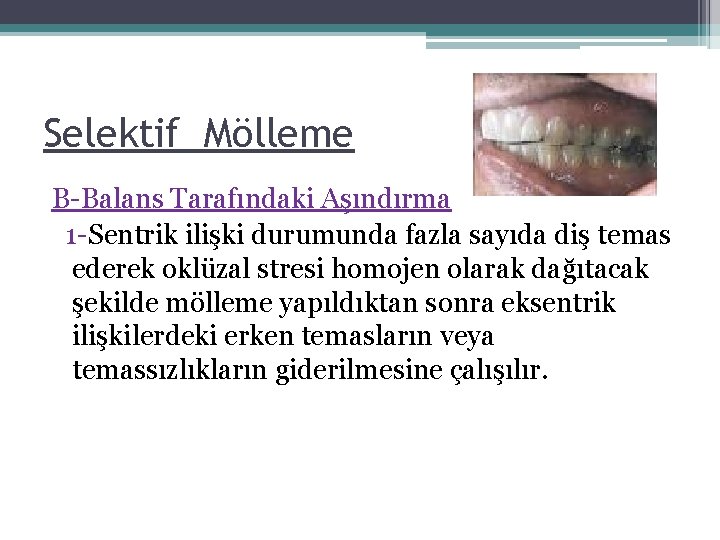 Selektif Mölleme B-Balans Tarafındaki Aşındırma 1 -Sentrik ilişki durumunda fazla sayıda diş temas ederek