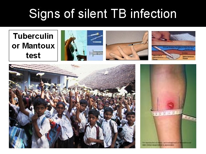 Signs of silent TB infection Tuberculin or Mantoux test 