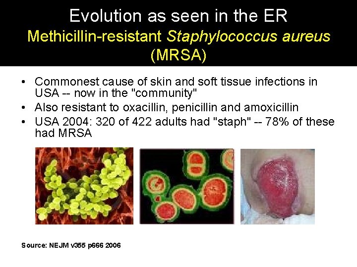 Evolution as seen in the ER Methicillin-resistant Staphylococcus aureus (MRSA) • Commonest cause of