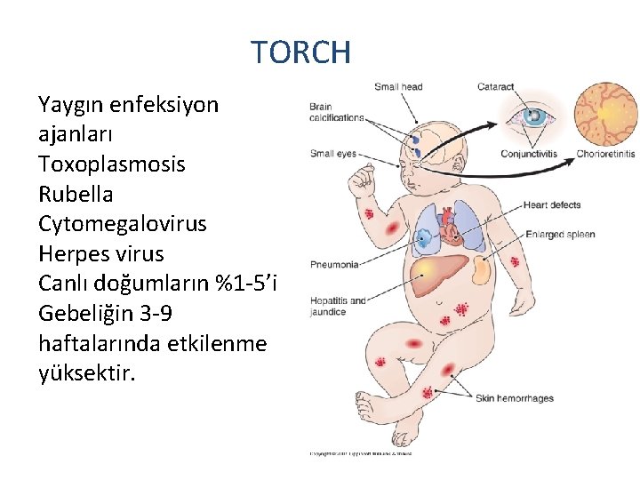 TORCH Yaygın enfeksiyon ajanları Toxoplasmosis Rubella Cytomegalovirus Herpes virus Canlı doğumların %1 -5’i Gebeliğin
