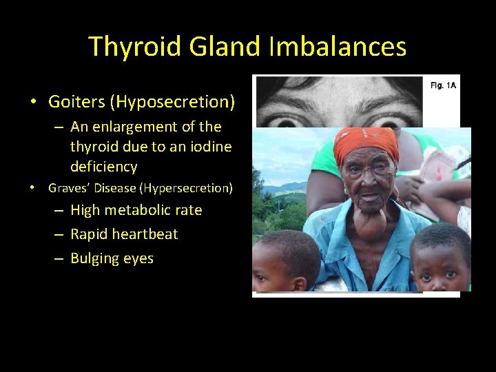 Thyroid Gland Imbalances • Goiters (Hyposecretion) – An enlargement of the thyroid due to