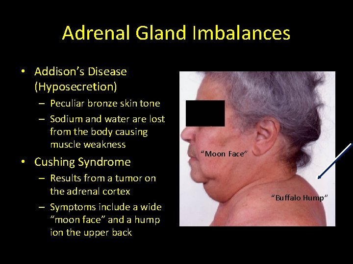 Adrenal Gland Imbalances • Addison’s Disease (Hyposecretion) – Peculiar bronze skin tone – Sodium