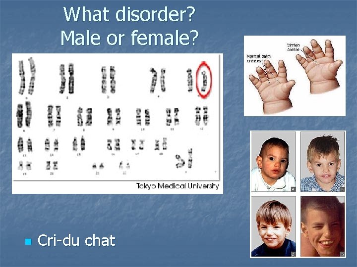 What disorder? Male or female? n Cri-du chat 