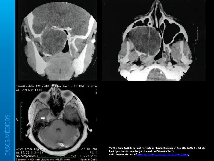 Tumores malignos de la vaina nerviosa periférica como origen de dolor orofacial. Author links