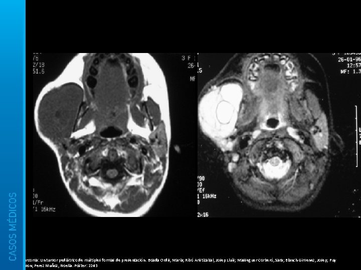 Rabdomiosarcoma: Un tumor pediátrico de múltiples formas de presentación. Boada Ordis, Maria; Ribó Aristizabal,