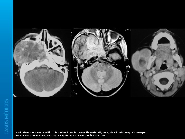 Rabdomiosarcoma: Un tumor pediátrico de múltiples formas de presentación. Boada Ordis, Maria; Ribó Aristizabal,