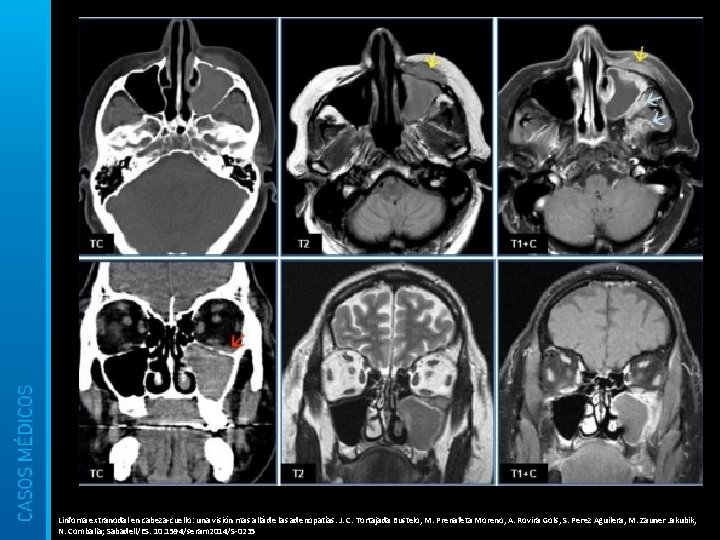 Linfoma extranodal en cabeza-cuello: una visión mas allá de las adenopatías. J. C. Tortajada