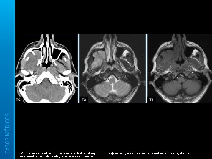 Linfoma extranodal en cabeza-cuello: una visión mas allá de las adenopatías. J. C. Tortajada