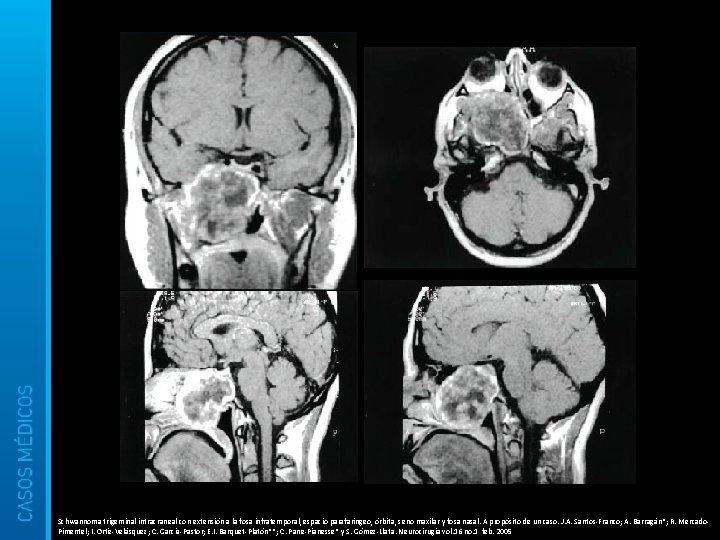 Schwannoma trigeminal intracraneal con extensión a la fosa infratemporal, espacio parafaríngeo, órbita, seno maxilar