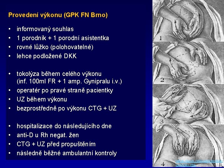 Provedení výkonu (GPK FN Brno) • • informovaný souhlas 1 porodník + 1 porodní
