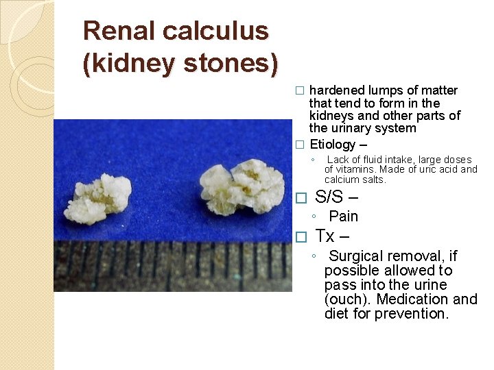 Renal calculus (kidney stones) hardened lumps of matter that tend to form in the