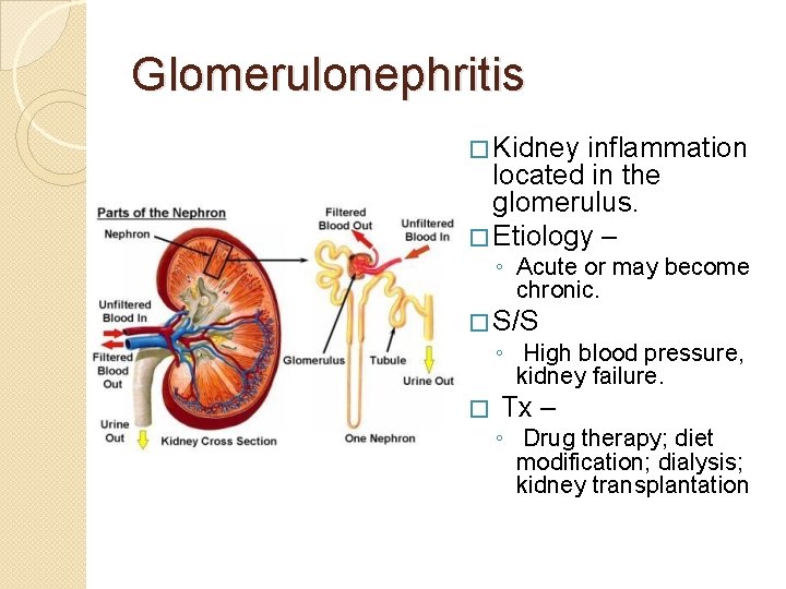 Glomerulonephritis � Kidney inflammation located in the glomerulus. � Etiology – ◦ Acute or