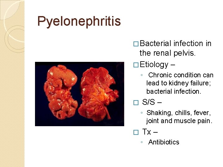 Pyelonephritis � Bacterial infection in the renal pelvis. � Etiology – ◦ Chronic condition