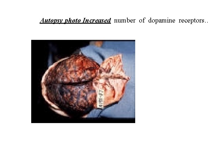 Autopsy photo Increased number of dopamine receptors… Autopsy photo Increased number of dopamine receptors…