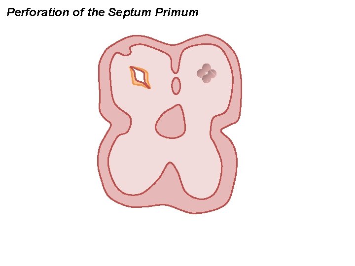Perforation of the Septum Primum 
