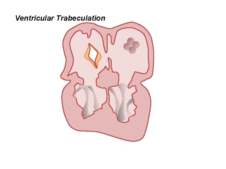 Ventricular Trabeculation 