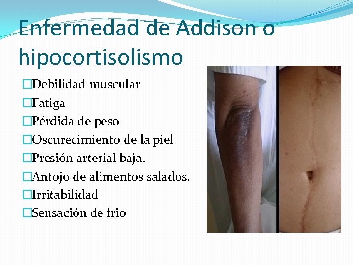 Enfermedad de Addison o hipocortisolismo �Debilidad muscular �Fatiga �Pérdida de peso �Oscurecimiento de la