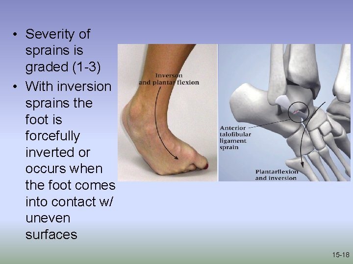  • Severity of sprains is graded (1 -3) • With inversion sprains the