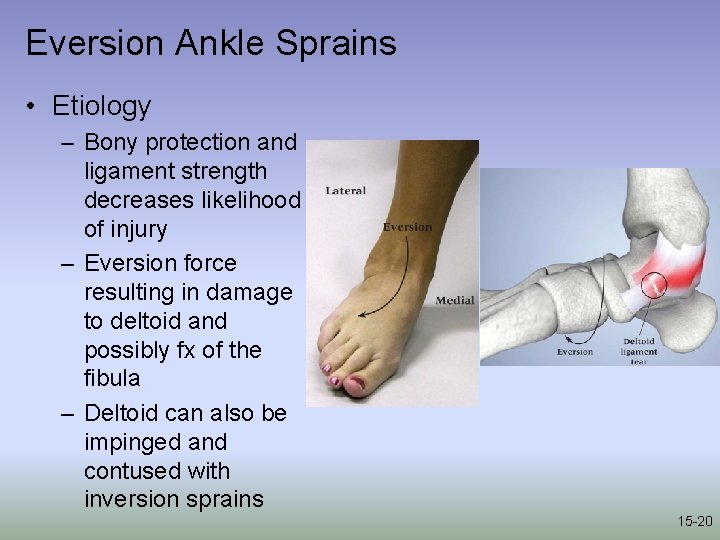 Eversion Ankle Sprains • Etiology – Bony protection and ligament strength decreases likelihood of