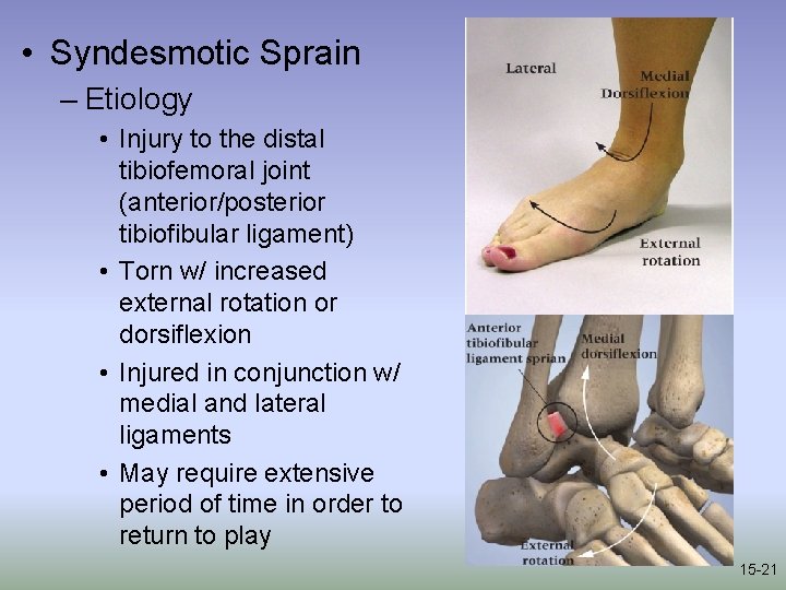  • Syndesmotic Sprain – Etiology • Injury to the distal tibiofemoral joint (anterior/posterior