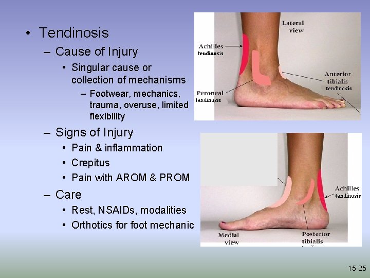  • Tendinosis – Cause of Injury • Singular cause or collection of mechanisms