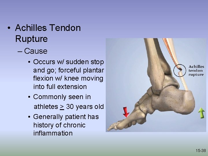  • Achilles Tendon Rupture – Cause • Occurs w/ sudden stop and go;