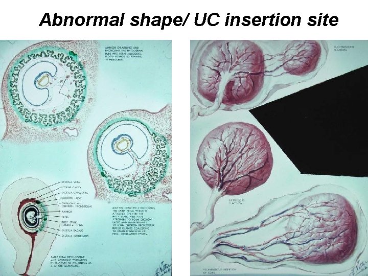 Abnormal shape/ UC insertion site 