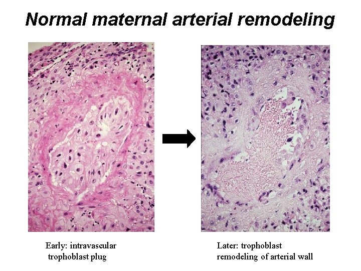 Normal maternal arterial remodeling Early: intravascular trophoblast plug Later: trophoblast remodeling of arterial wall