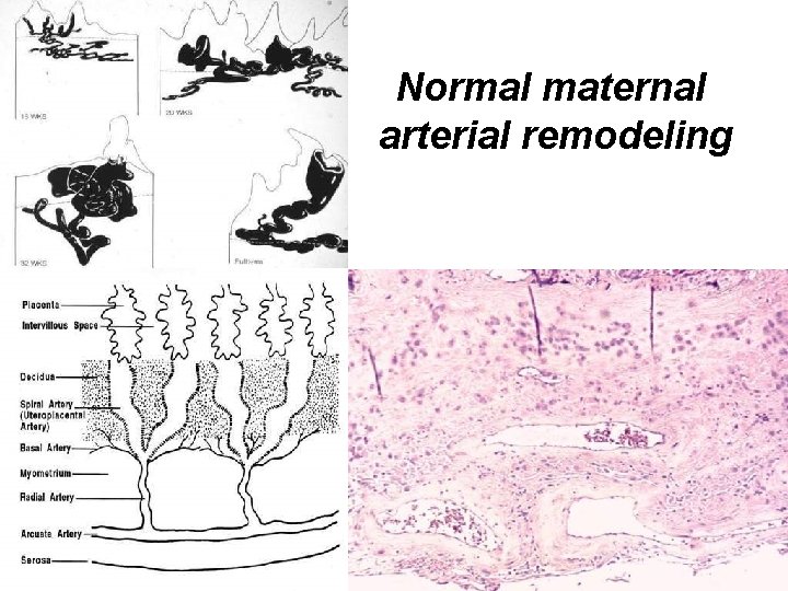 Normal maternal arterial remodeling 