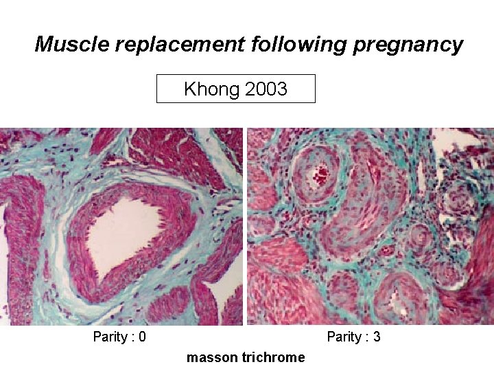 Muscle replacement following pregnancy Khong 2003 Parity : 0 Parity : 3 masson trichrome