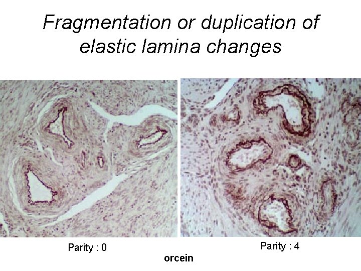 Fragmentation or duplication of elastic lamina changes Parity : 0 Parity : 4 orcein