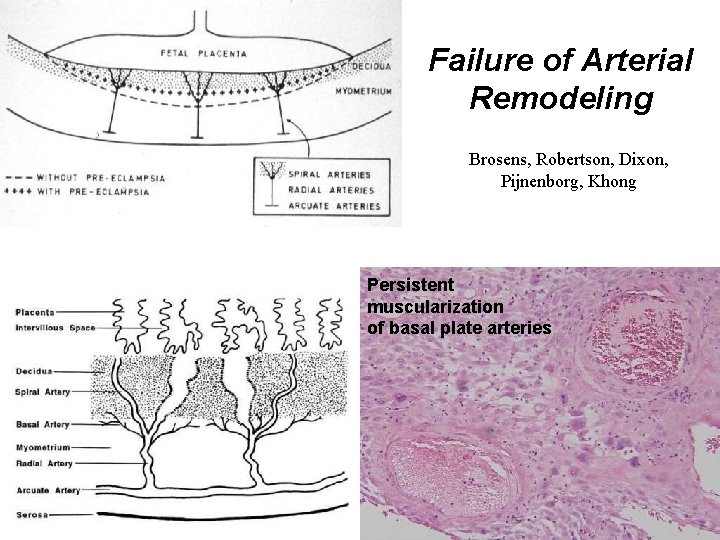 Failure of Arterial Remodeling Brosens, Robertson, Dixon, Pijnenborg, Khong Persistent muscularization of basal plate