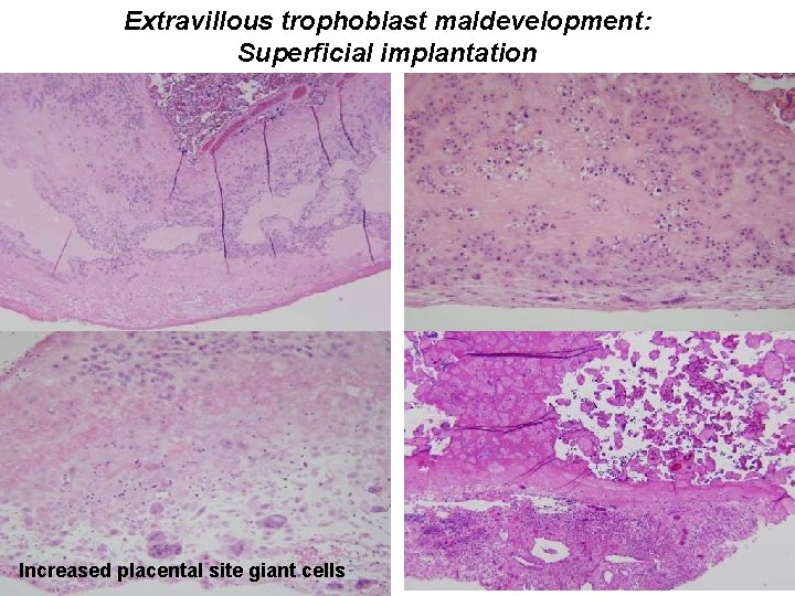 Extravillous trophoblast maldevelopment: Superficial implantation Increased placental site giant cells 