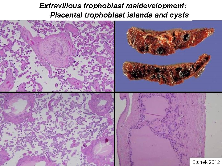 Extravillous trophoblast maldevelopment: Placental trophoblast islands and cysts Stanek 2012 