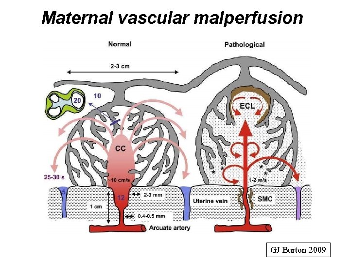 Maternal vascular malperfusion GJ Burton 2009 